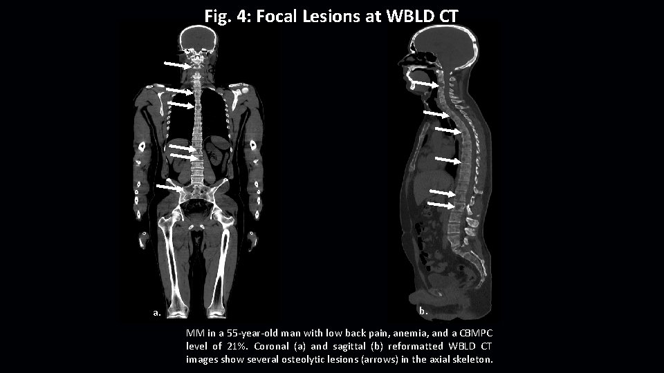 Fig. 4: Focal Lesions at WBLD CT a. b. MM in a 55 -year-old