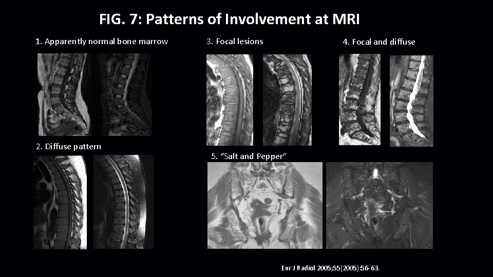 FIG. 7: Patterns of Involvement at MRI 1. Apparently normal bone marrow 2. Diffuse