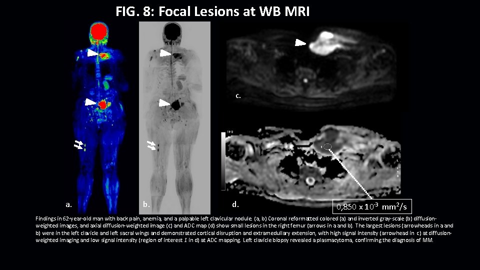 FIG. 8: Focal Lesions at WB MRI c. a. b. d. 0, 850 x