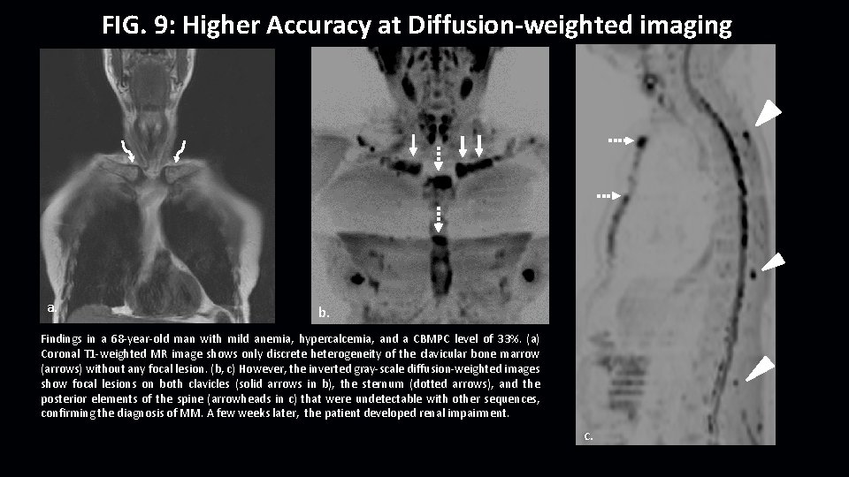 FIG. 9: Higher Accuracy at Diffusion-weighted imaging a. b. Findings in a 68 -year-old