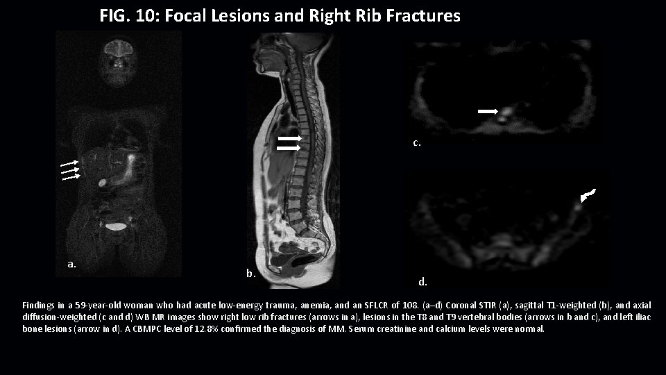 FIG. 10: Focal Lesions and Right Rib Fractures c. a. b. d. Findings in