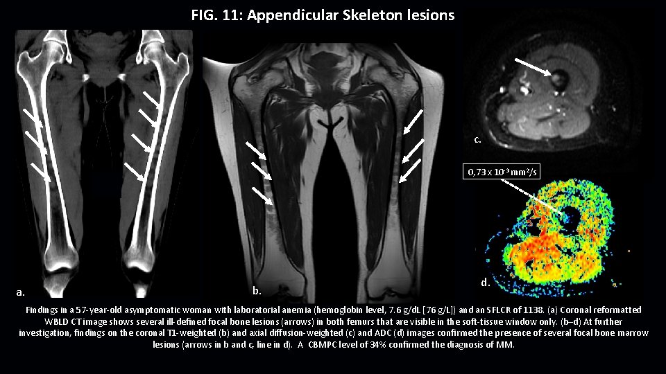 FIG. 11: Appendicular Skeleton lesions c. 0, 73 x 10 -3 mm 2/s a.