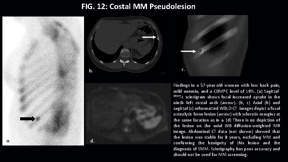 FIG. 12: Costal MM Pseudolesion b. a. d. c. Findings in a 57 -year-old