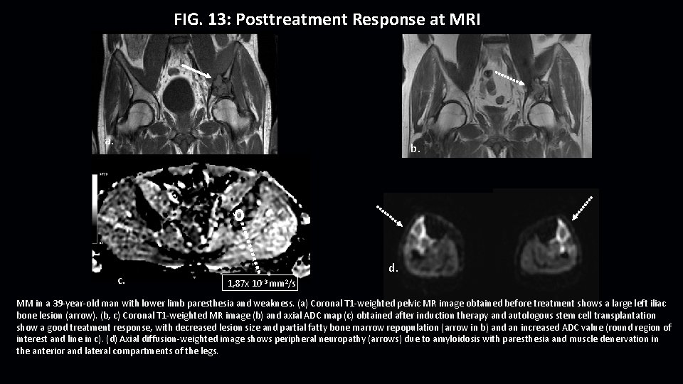 FIG. 13: Posttreatment Response at MRI a. b. c. d. 1, 87 x 10