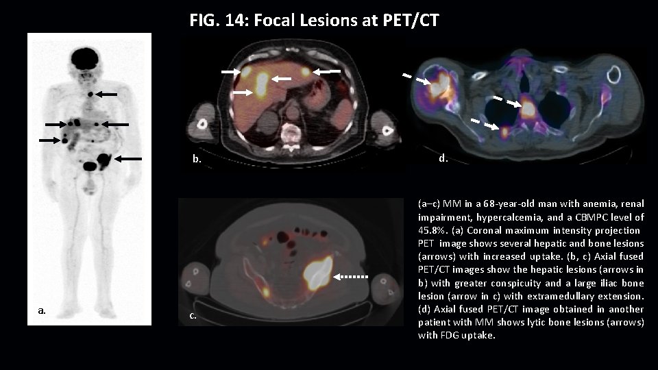 FIG. 14: Focal Lesions at PET/CT b. a. c. d. (a–c) MM in a