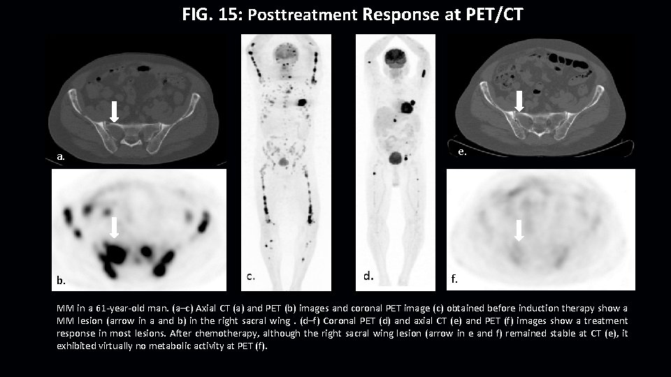 FIG. 15: Posttreatment Response at PET/CT e. a. b. f. MM in a 61