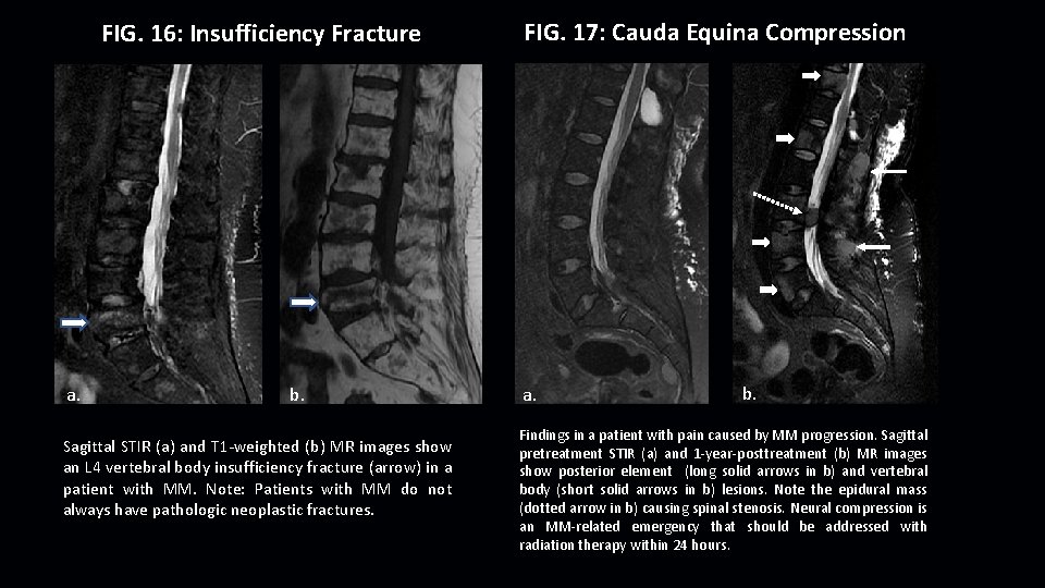 FIG. 16: Insufficiency Fracture a. b. Sagittal STIR (a) and T 1 -weighted (b)