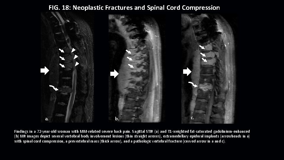 FIG. 18: Neoplastic Fractures and Spinal Cord Compression a. b. c. Findings in a