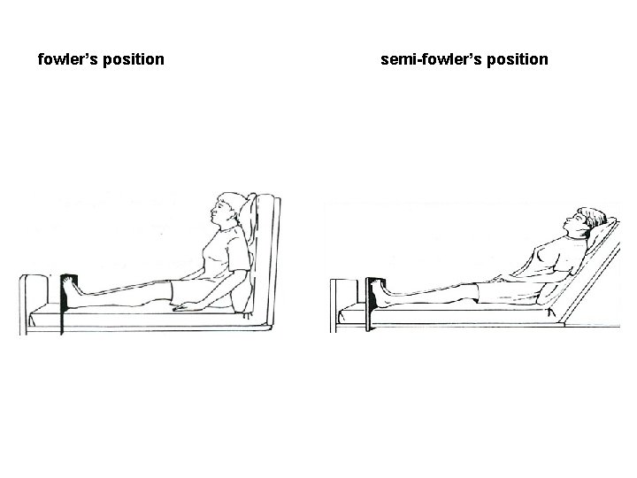 fowler’s position semi-fowler’s position 