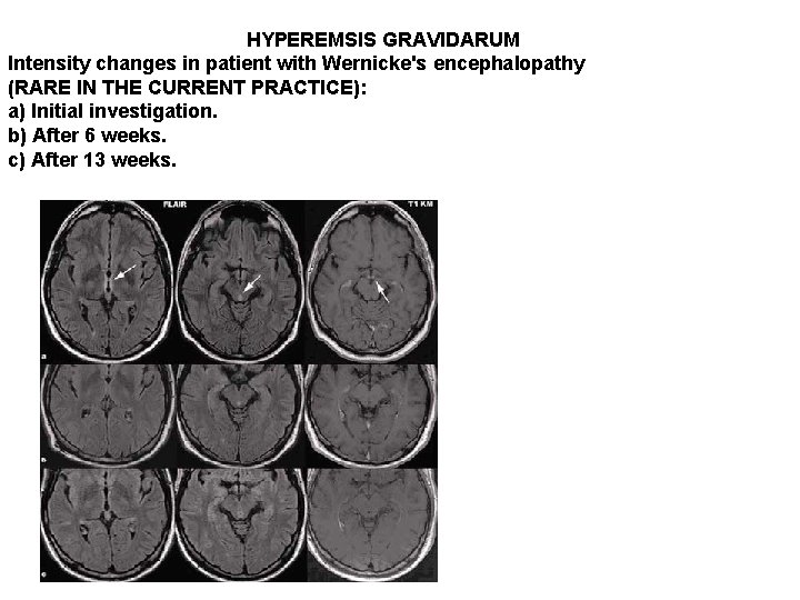 HYPEREMSIS GRAVIDARUM Intensity changes in patient with Wernicke's encephalopathy (RARE IN THE CURRENT PRACTICE):