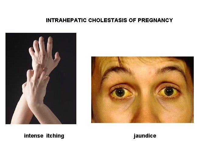 INTRAHEPATIC CHOLESTASIS OF PREGNANCY intense itching jaundice 