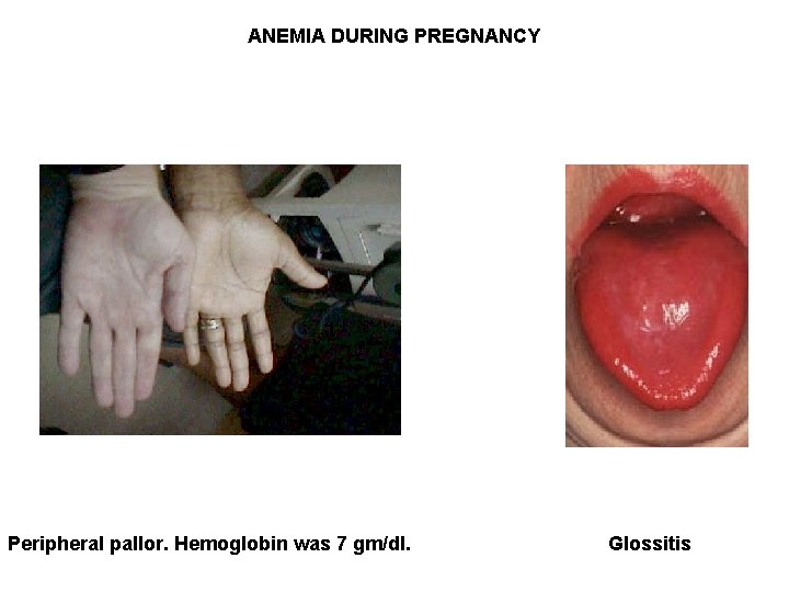 ANEMIA DURING PREGNANCY Peripheral pallor. Hemoglobin was 7 gm/dl. Glossitis 