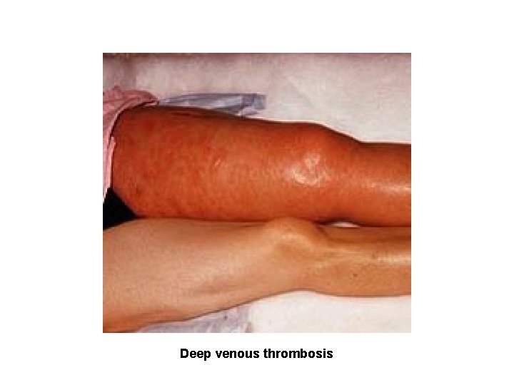 Deep venous thrombosis 