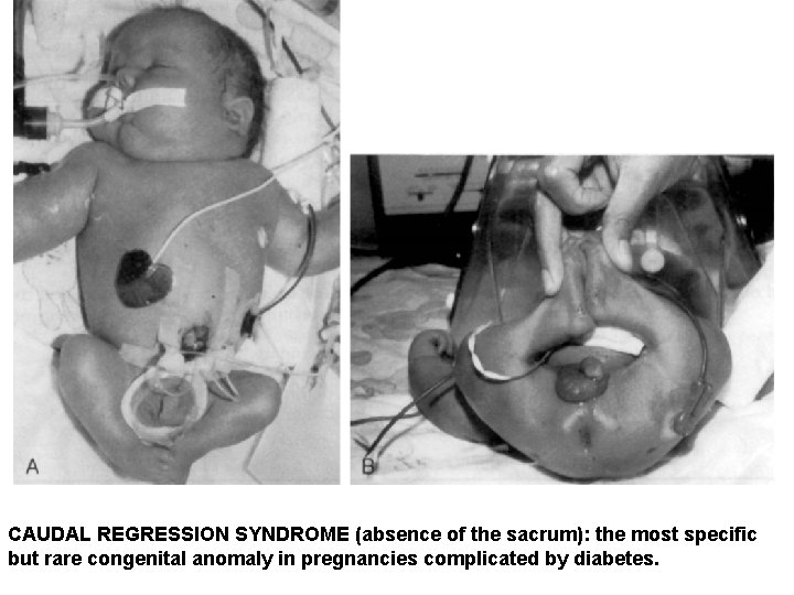 CAUDAL REGRESSION SYNDROME (absence of the sacrum): the most specific but rare congenital anomaly