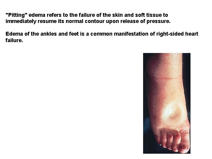 "Pitting" edema refers to the failure of the skin and soft tissue to immediately