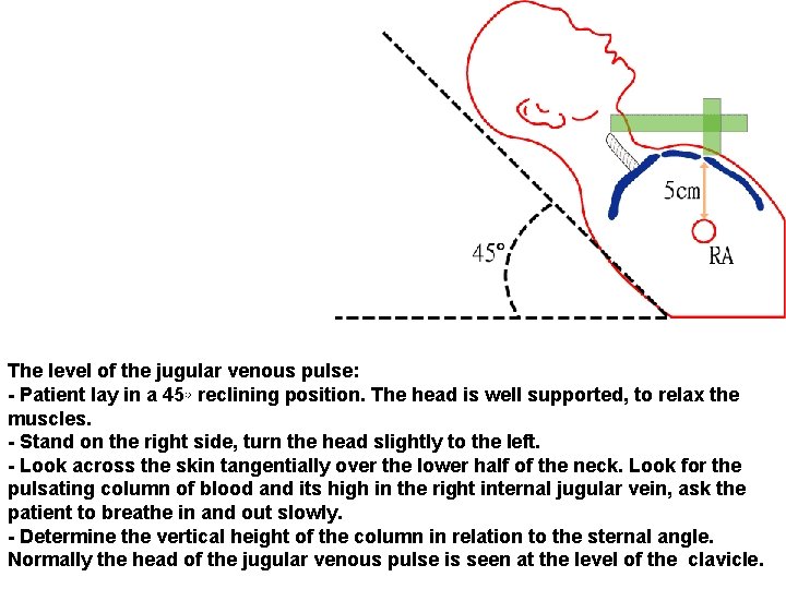 The level of the jugular venous pulse: - Patient lay in a 45◦ reclining