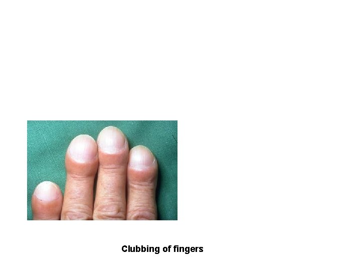 Clubbing of fingers 