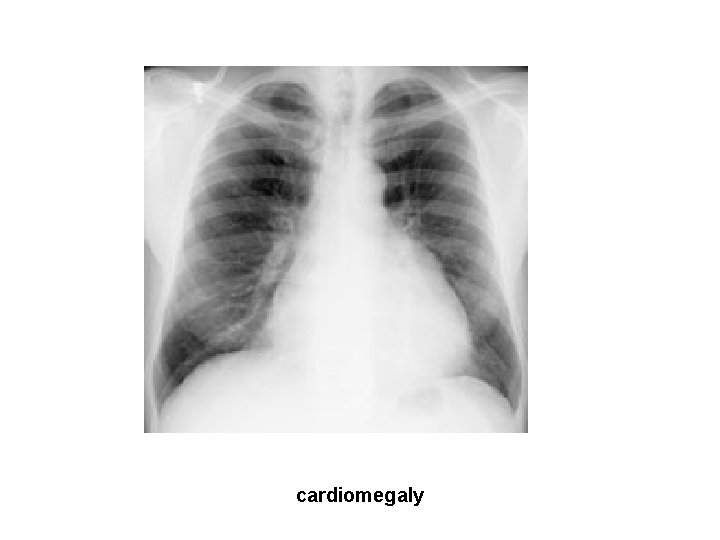 cardiomegaly 