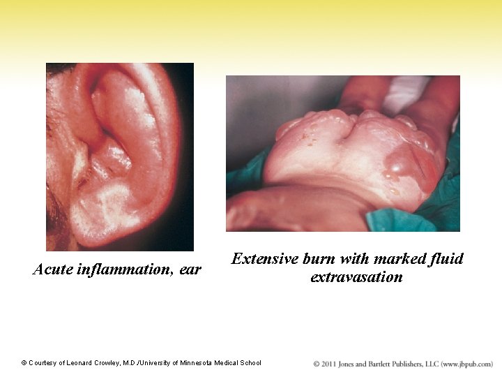 Acute inflammation, ear Extensive burn with marked fluid extravasation © Courtesy of Leonard Crowley,