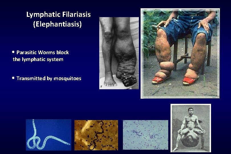Lymphatic Filariasis (Elephantiasis) • Parasitic Worms block the lymphatic system • Transmitted by mosquitoes