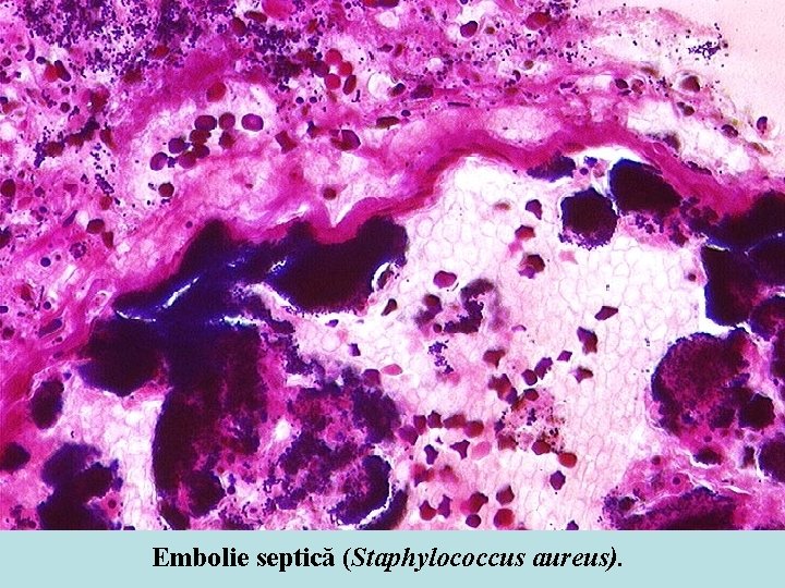 Embolie septică (Staphylococcus aureus). 