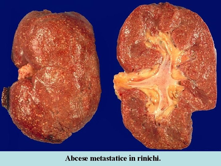 Abcese metastatice în rinichi. 