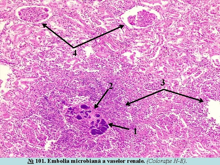 4 3 2 1 № 101. Embolia microbiană a vaselor renale. (Coloraţie H-E). 