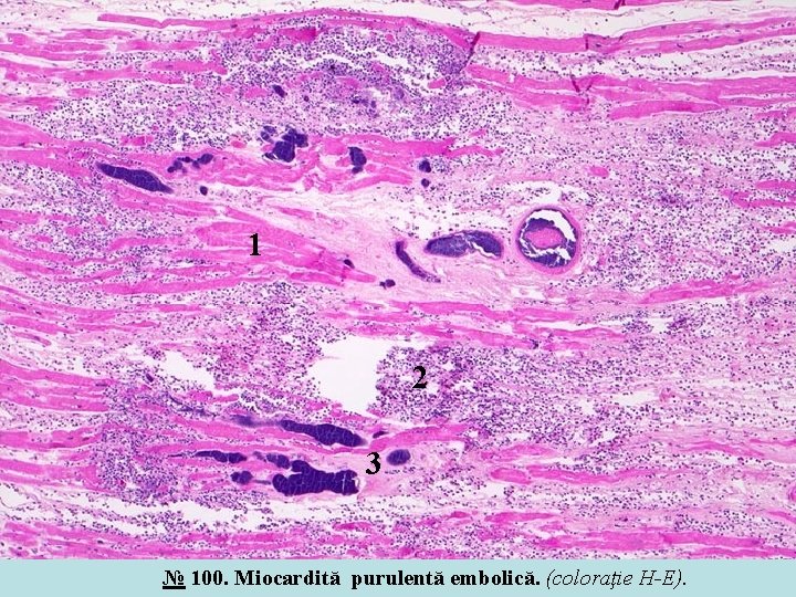 1 2 3 № 100. Miocardită purulentă embolică. (coloraţie H-E). 