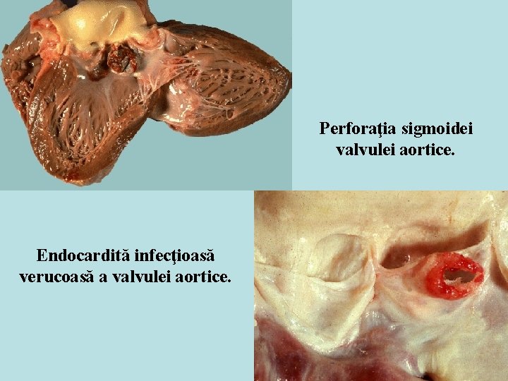 Perforaţia sigmoidei valvulei aortice. Endocardită infecţioasă verucoasă a valvulei aortice. 
