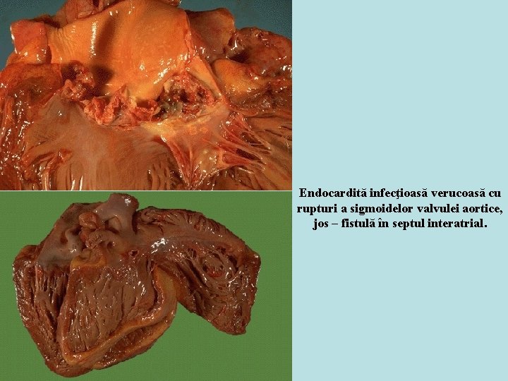 Endocardită infecţioasă verucoasă cu rupturi a sigmoidelor valvulei aortice, jos – fistulă în septul