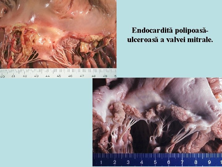 Endocardită polipoasăulceroasă a valvei mitrale. 