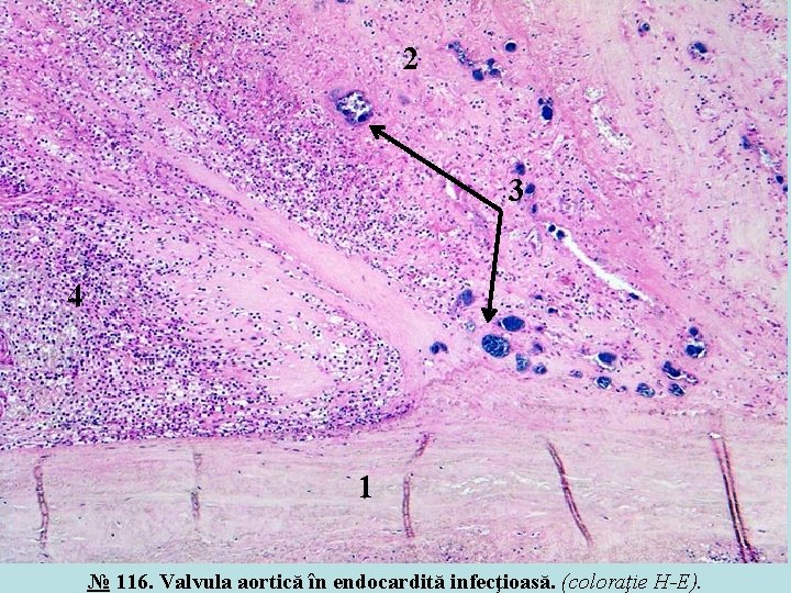 2 3 4 1 № 116. Valvula aortică în endocardită infecţioasă. (coloraţie H-E). 