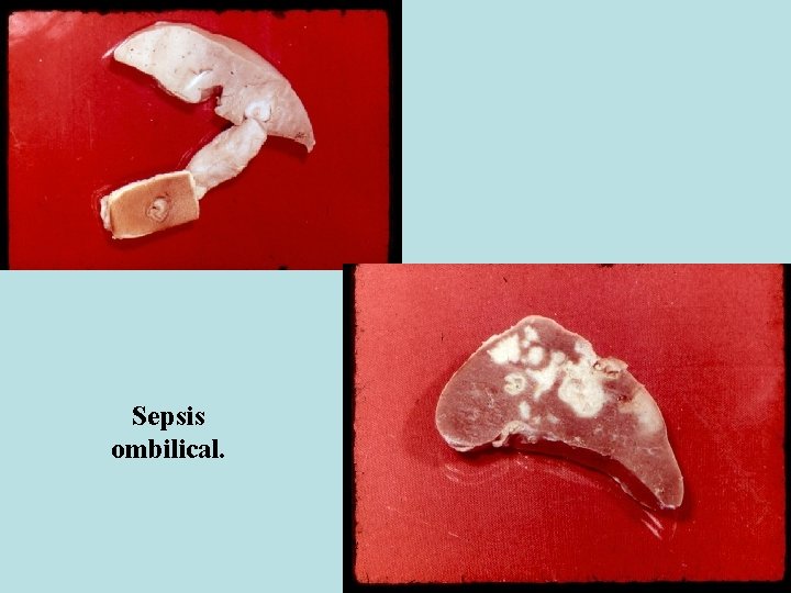 Sepsis ombilical. 