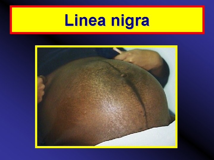 Linea nigra 