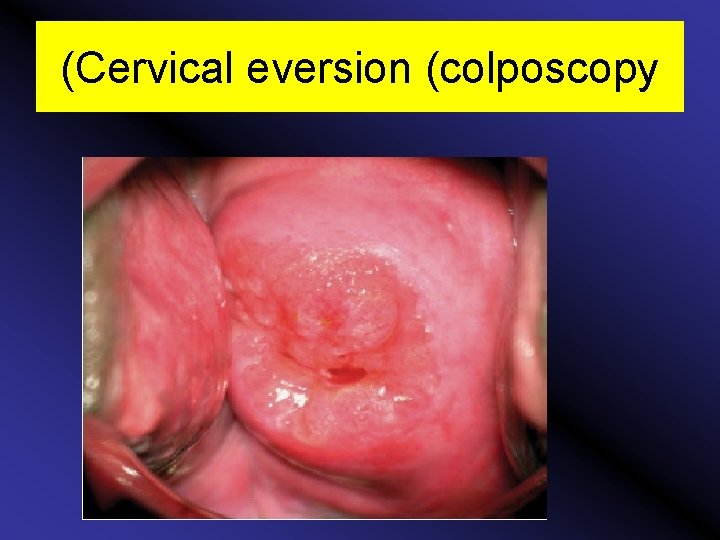 (Cervical eversion (colposcopy 