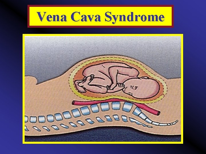 Vena Cava Syndrome 