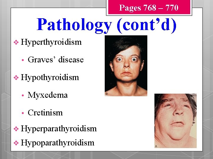 Pages 768 – 770 Pathology (cont’d) v Hyperthyroidism • Graves’ disease v Hypothyroidism •