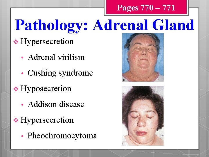 Pages 770 – 771 Pathology: Adrenal Gland v Hypersecretion • Adrenal virilism • Cushing