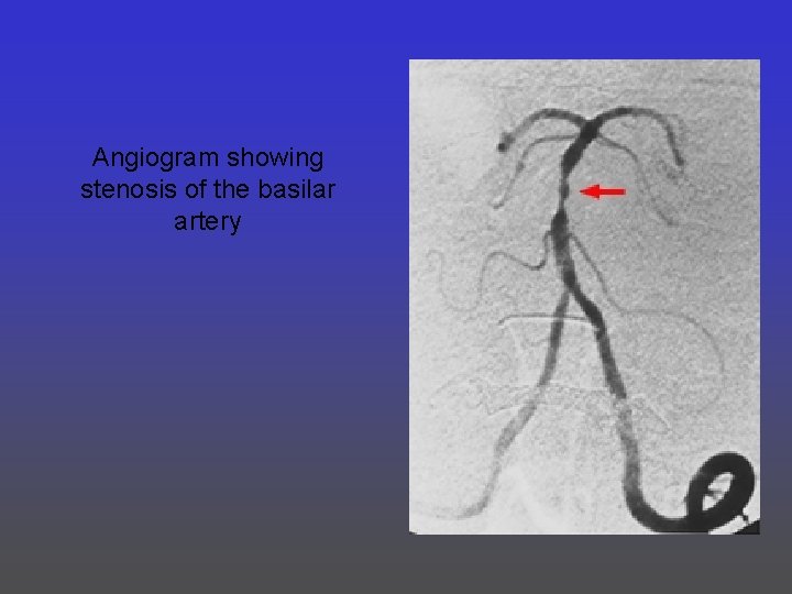 Angiogram showing stenosis of the basilar artery 