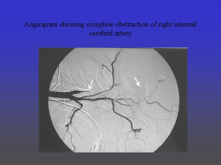 Angiogram showing complete obstruction of right internal cerebral artery 