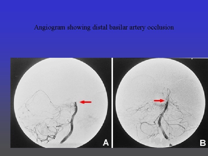 Angiogram showing distal basilar artery occlusion 