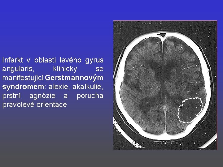 Infarkt v oblasti levého gyrus angularis, klinicky se manifestující Gerstmannovým syndromem: alexie, akalkulie, prstní