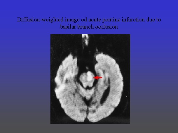 Diffusion-weighted image od acute pontine infarction due to basilar branch occlusion 