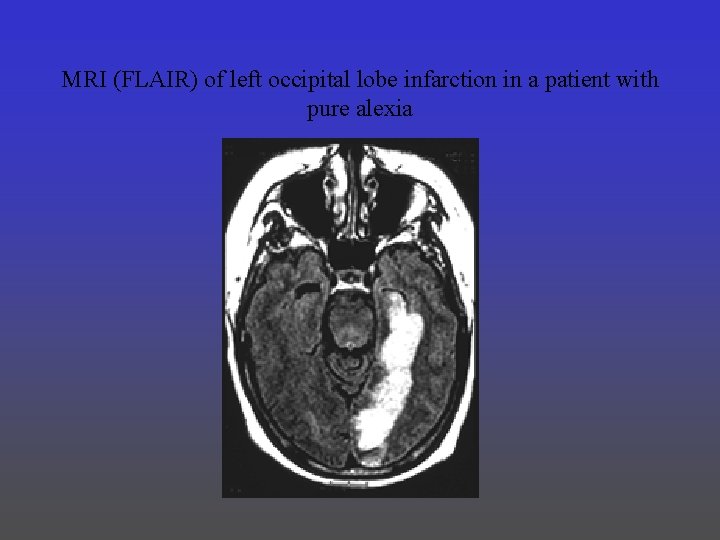 MRI (FLAIR) of left occipital lobe infarction in a patient with pure alexia 