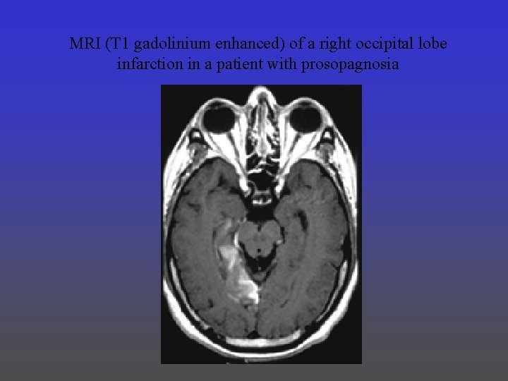MRI (T 1 gadolinium enhanced) of a right occipital lobe infarction in a patient