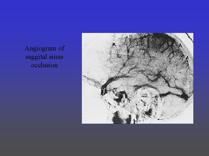 Angiogram of saggital sinus occlusion 