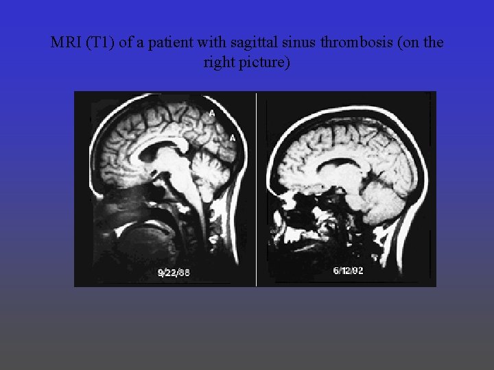 MRI (T 1) of a patient with sagittal sinus thrombosis (on the right picture)