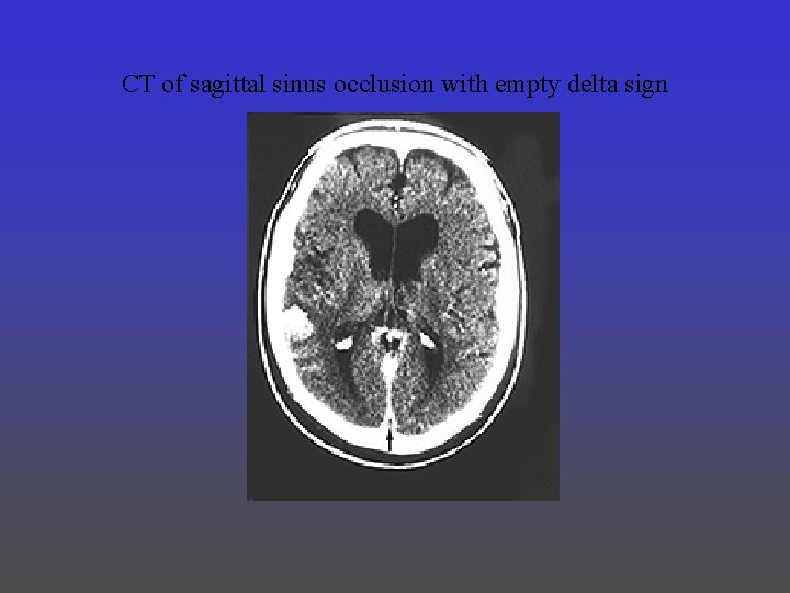 CT of sagittal sinus occlusion with empty delta sign 