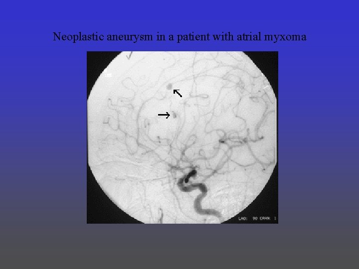 Neoplastic aneurysm in a patient with atrial myxoma 
