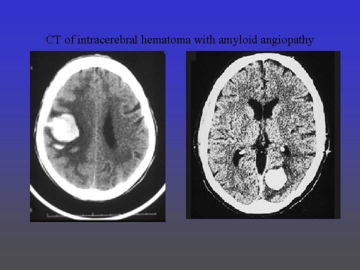 CT of intracerebral hematoma with amyloid angiopathy 